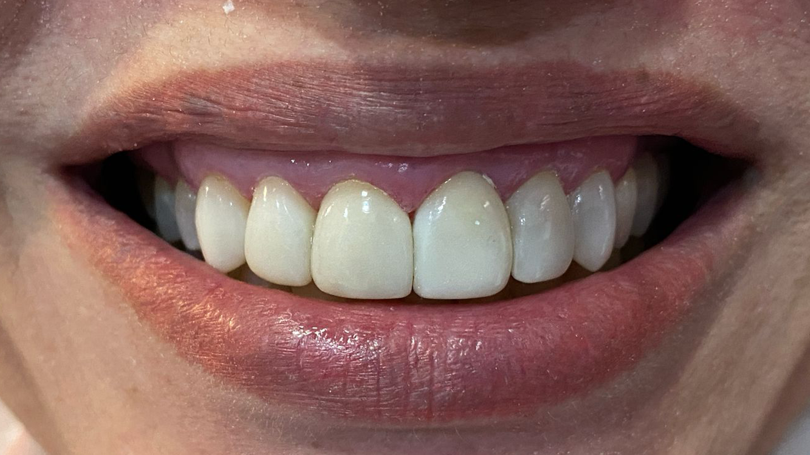 Sorriso renovado 3